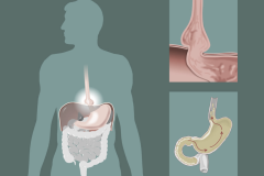 hi - hernia-hiatal-1